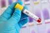 Учени излекуваха ХИВ за втори път от появата на СПИН